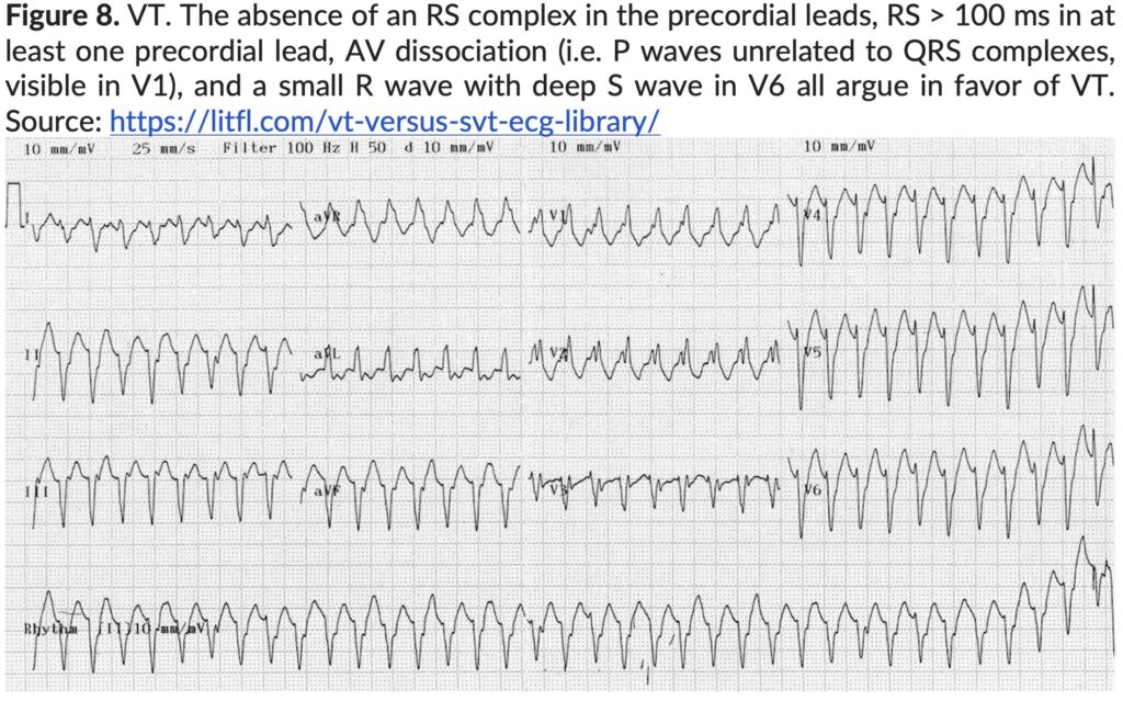 Figure 8. VT. The absence of an RS Complex.